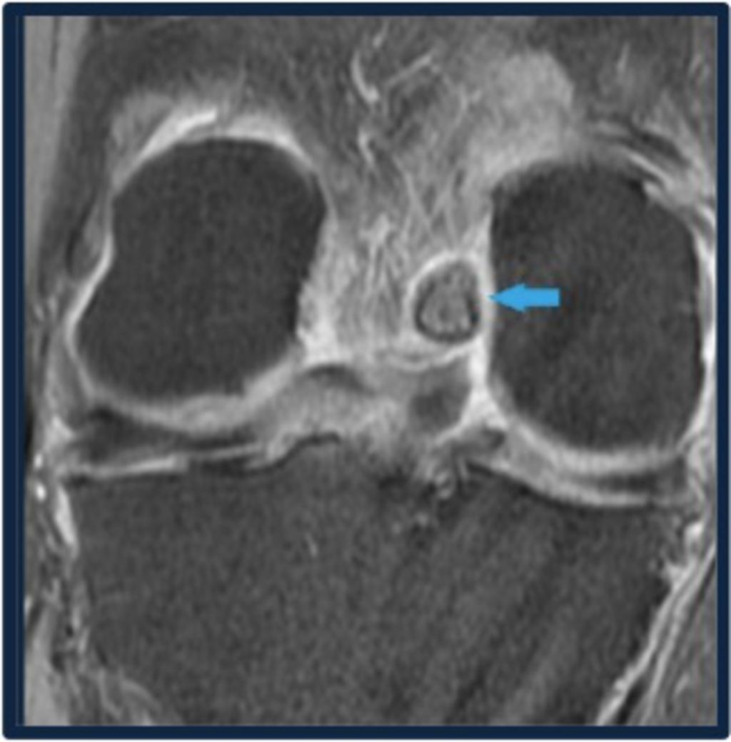 Fig. 8: Coronal PDFS image shows LOOSE BODY in posterior