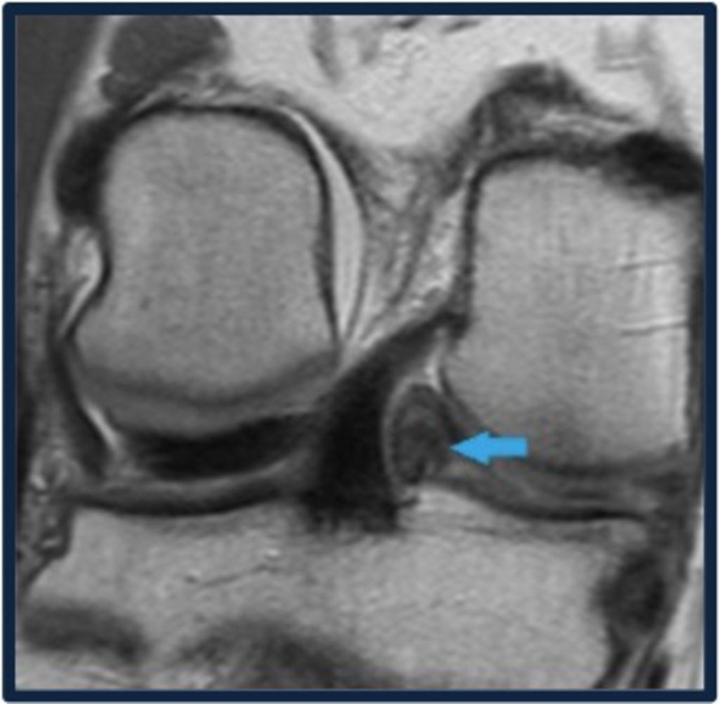 Fig. 7: Coronal PD image shows FOLDED MENISCAL FRAGMENT in