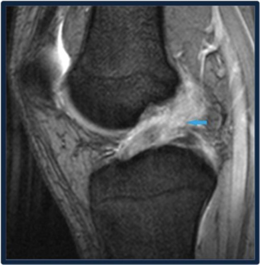 Fig. 1: Sagittal T2* sequence showing TORN ACL (blue arrow).