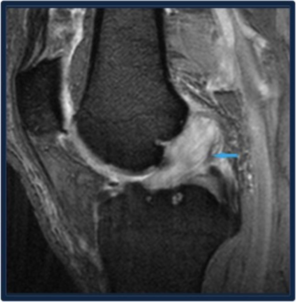 Fig. 2: Sagittal Gradient sequence showing MUCOID degeneration of ACL with positive celery