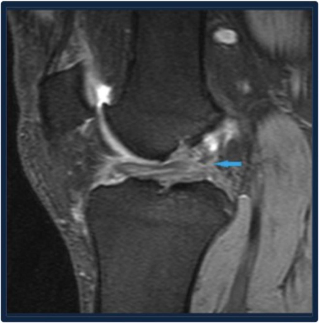 Fig. 3: Sagittal PDFS image show BUCKET HANDLE TEAR with torn MENISCAL
