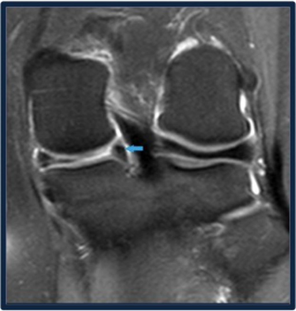 Fig. 4: Coronal PDFS image show BUCKET HANDLE TEAR with torn MENISCAL