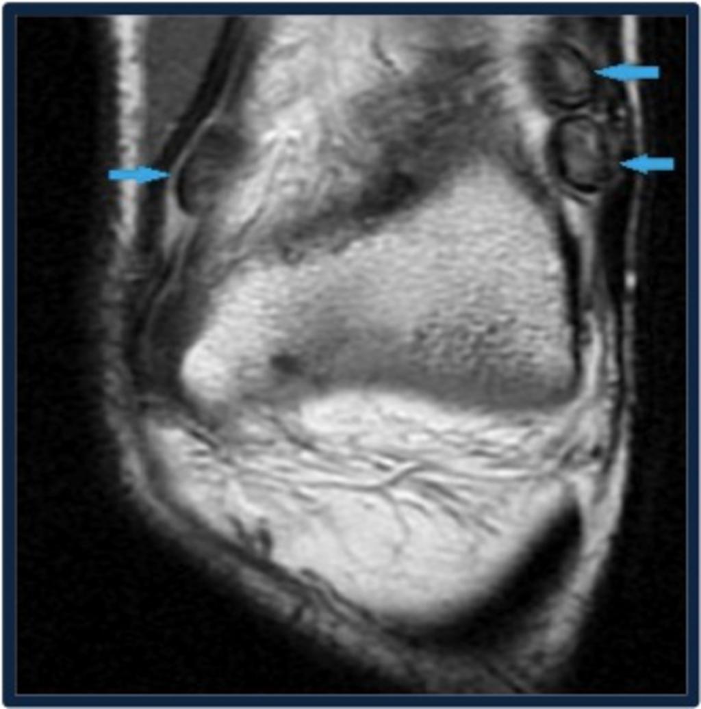 Fig. 14: Coronal PD image shows SYNOVIAL
