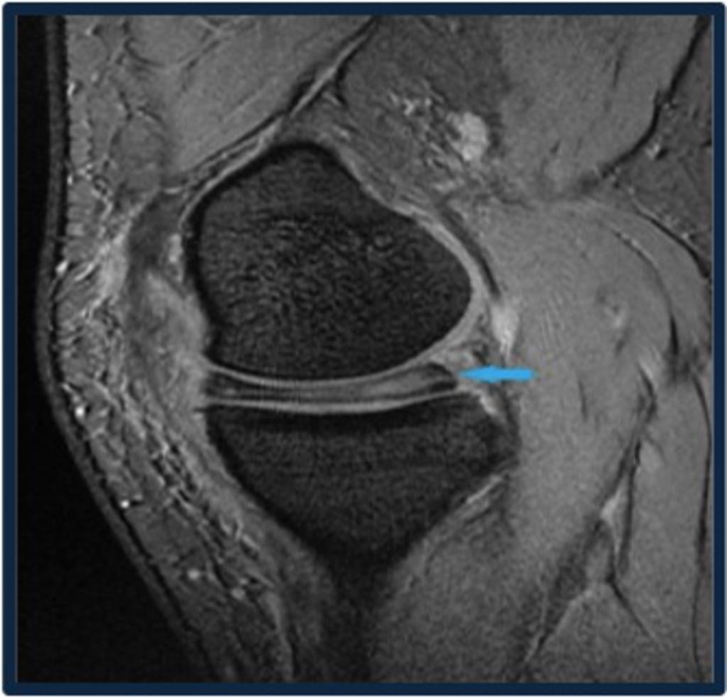 Fig. 13: Sagittal Gradient image shows DISCOID MENISCUS as cause of