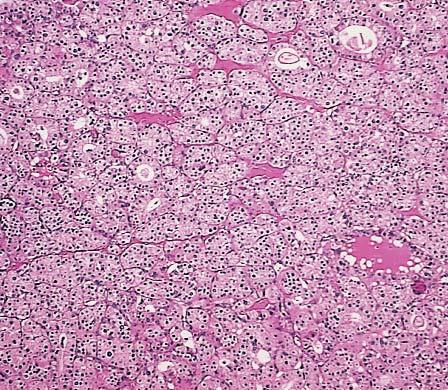 Suster and Moran / NEUROENDOCRINE NEOPLASMS OF THE MEDIASTINUM Image 17 Mediastinal parathyroid adenoma (H&E, 40). carcinomas of internal organs.