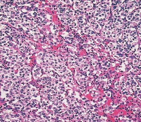 Well-Differentiated Thymic Neuroendocrine Carcinomas Well-differentiated thymic neuroendocrine carcinomas are characterized by a well-developed neuroendocrine (organoid) growth pattern with mild to