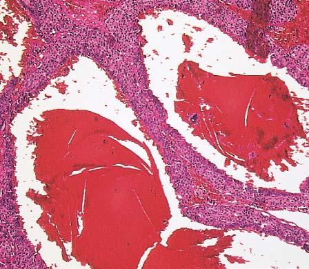 Moderately Differentiated Thymic Neuroendocrine Carcinoma Although the growth pattern of these tumors may be similar to those of the well-differentiated group, there is a greater