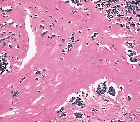 Image 7 Neuroendocrine carcinoma of the thymus with amyloid-like stroma simulating medullary carcinoma of thyroid (H&E, 100).