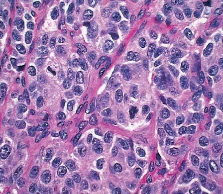 nucleoli, coarse chromatin pattern, and frequent mitotic figures (4-10 mitoses per 10 HPF) Image 8. Vascular invasion is also frequent.
