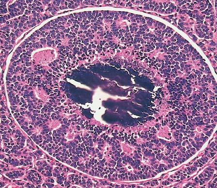 These tumor balls frequently display a prominent clefting artifact from the surrounding tumor cells and usually are composed of atypical cells with frequent mitotic figures.