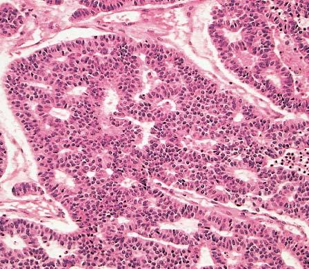Moderately differentiated neuroendocrine carcinomas also frequently show a tendency to grow in a diffuse, sheet-like pattern that may closely resemble a malignant lymphoma Image 11.