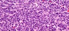 Poorly Differentiated Neuroendocrine Neoplasms Two different families