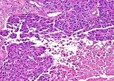 Recognition of Neuroendocrine Differentiation PET-CT Poorly Differentiated Neuroendocrine Carcinoma Recognition of Neuroendocrine Differentiation: Immunohistochemical Markers Conventional markers A