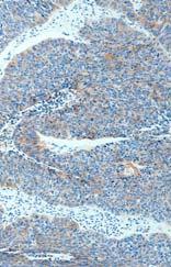 95% (58) Glioma 36% (148) Dendritic cell tumor 94% (164) Nk T-cell lymphoma 74% (267) Chloroma 27% (62) Source: Immunoquery Immunohistochemical Staining for the Diagnosis of Well Differentiated