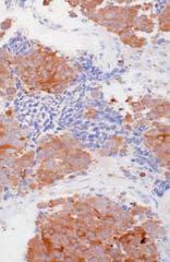 Large Cell Neuroendocrine Carcinoma Chr