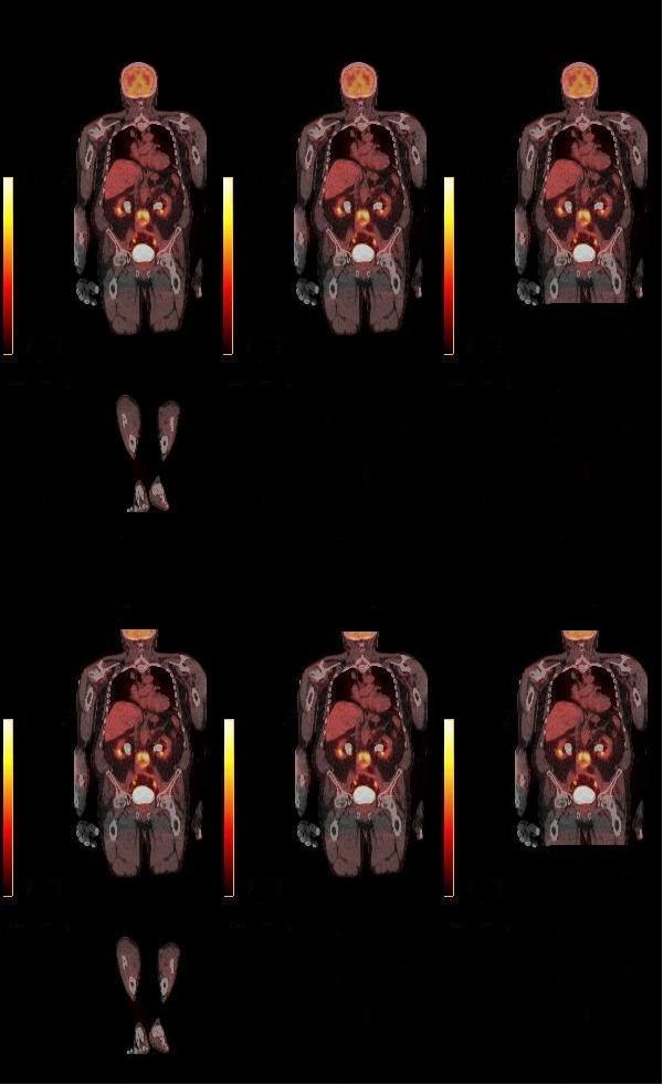 Some PET/CT FOV: Top left true whole body Top middle vertex to mid-thighs Top right vertex to upper thighs Bottom left skull base to toes Bottom middle skull base to mid-thighs Bottom right skull