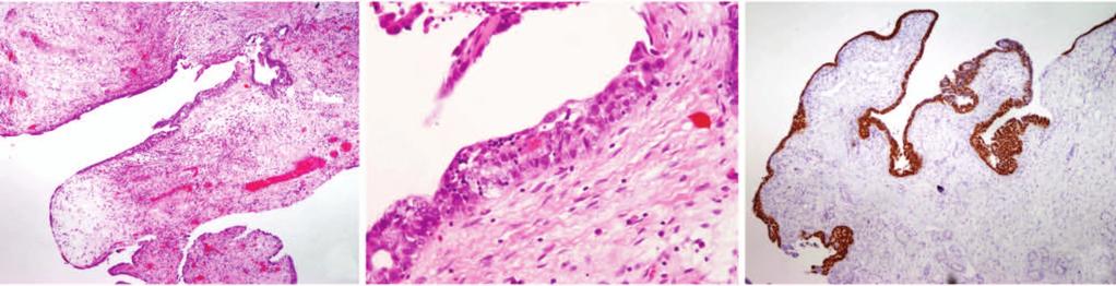 a b c Slika 1. Serozni intraepitelni karcinom jajovoda (STIC).
