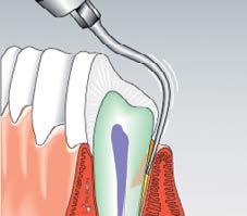 KaVo SONICflex tips overview Periodontology Protection of the collagenous soft tissue and the root