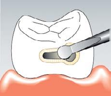 Minimally-Invasive Surgery Minimally-invasive therapy, for incipient caries Safe and ultra-conservative, caries excavation