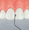 30 Therapy: minimally-invasive treatment, for incipient caries Form: small hemisphere, mesial, diamond coating D46 Maximum