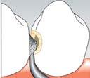 1969 (30A)  31 Therapy: minimally-invasive treatment, for incipient caries Form: small hemisphere, distal, diamond coating