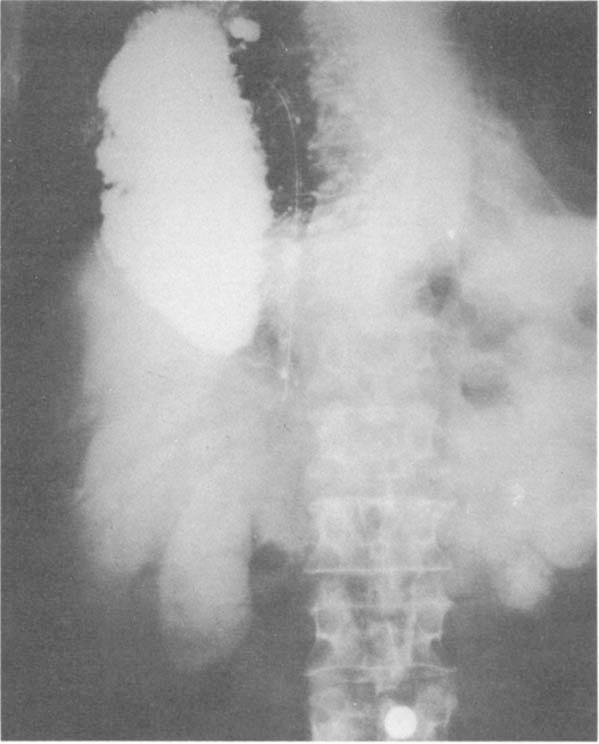 Five years later the patient was admitted with upper gastrointestinal (GI) bleeding. She was found to have a gastric ulcer and underwent excisional biopsy, primary closure, and hemigastrectomy.
