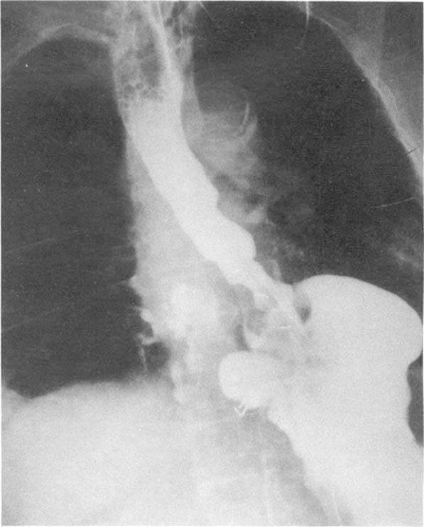 A 77-year-old woman had undergone transabdominal Nissen fundoplication five years prior to admission. For the past three years she had experienced increasing dysphagia.