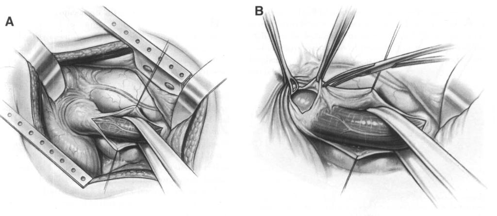 NISSEN FUNDOPLICATION 41 2-1 The transthoraric procedure is performed via a left thoracotomy through the bed of the nonresected 8th rib, the angle of which m a y be divided for additional exposure.
