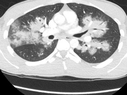 Our patient: Axial chest CT, C+, middle level Bilateral peribronchial