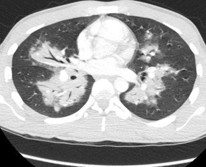 Our patient: Axial chest CT, C+, inferior level Bilateral peribronchial