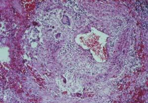 Granulomatosis with Polyangiitis (Wegener s) Vasculitis of small arteries and veins Necrotizing granulomas C ANCA and anti proteinase 3