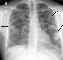 Companion patient 1: Classic GPA on Chest x ray Multiple,