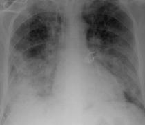 Companion patient 3: Pulmonary Hemorrhage in GPA on Chest x ray Multiple,