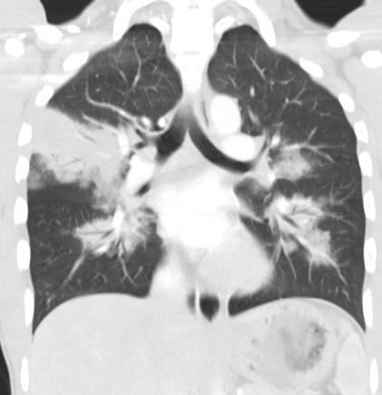 Our patient: Review of coronal CT, C+ Peripheral RUL consolidation