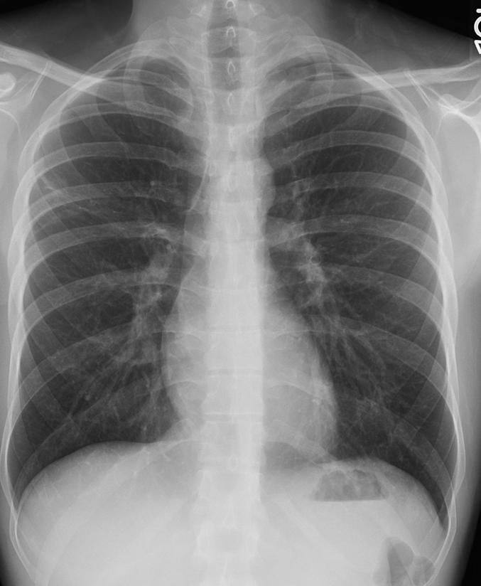 Our patient: Chest x ray post treatment Improved on steroids Rituximab as outpatient