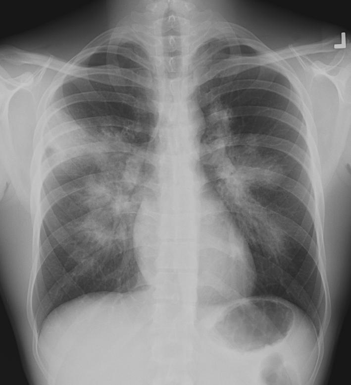 Our patient: Initial chest x ray, findings Diffuse, dense,