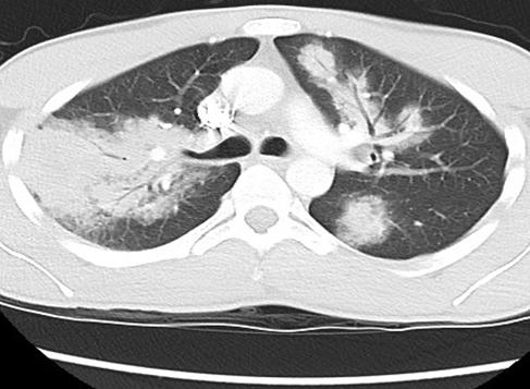 Our patient: Axial chest CT, C+, superior level Peripheral RUL consolidation
