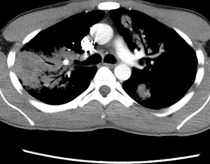 Our patient: Axial chest CT, C+, soft tissue window Peripheral RUL