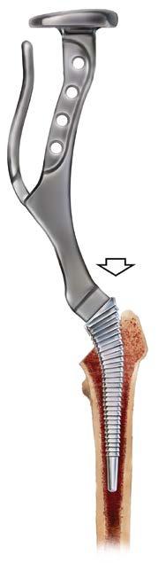 Beginning with the smallest CORAIL Compaction Broach attached to the selected broach handle, progressively enlarge the metaphyseal cavity by compacting and shaping the cancellous bone until the level