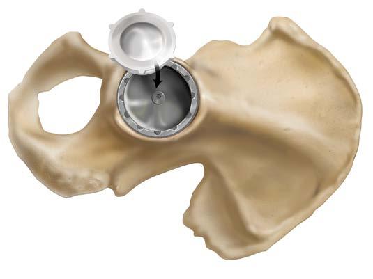 Surgical Technique 9 Acetabular Insert Implantation Following the final trial reduction, remove the trial acetabular liner