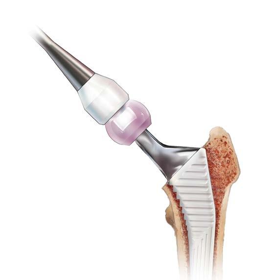 Figure 9 10 Femoral Head Impaction Irrigate, clean and dry the prosthesis to ensure the taper is free of debris.