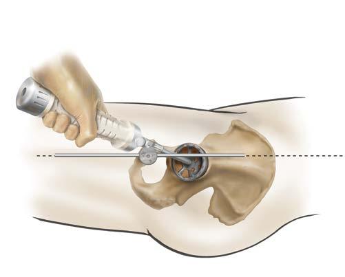 2 Reaming and alignment Make sure that the acetabulum is fully exposed and remove soft tissue from the acetabular rim.