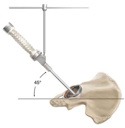 Using the cup impactor, place a trial cup sizer into the reamed acetabulum and assess its position and cortical bone contact.