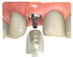 Two-stage or submerged surgery In the two-stage surgical procedure, the implant is placed below the soft tissue to protect it from occlusal function, bacteria and external forces during