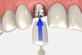prosthetic options Temporary restorations Temporary restorations may be used at any stage of implant therapy.