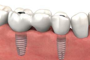 Ideally designed temporaries provide predictable tissue contouring in esthetic areas and may be cement-retained or