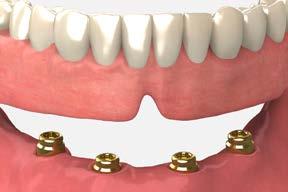 restoration Overdenture restorations Tissue-supported, implant-retained overdentures are an option for retaining a new or existing denture.