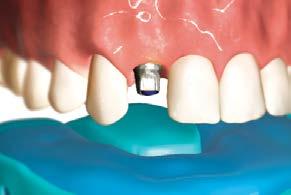 For a Simple Solutions abutment impression, refer to the Simple Solutions snap-cap impression technique module.