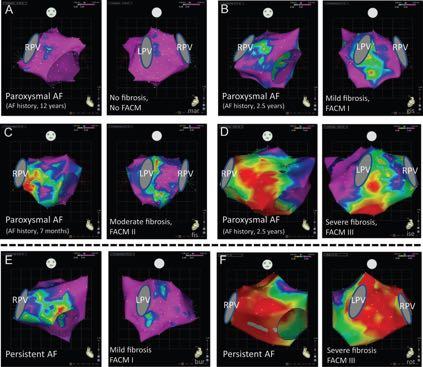 Electroanatomic Left Atrial Voltage Mapping In Pts With AF