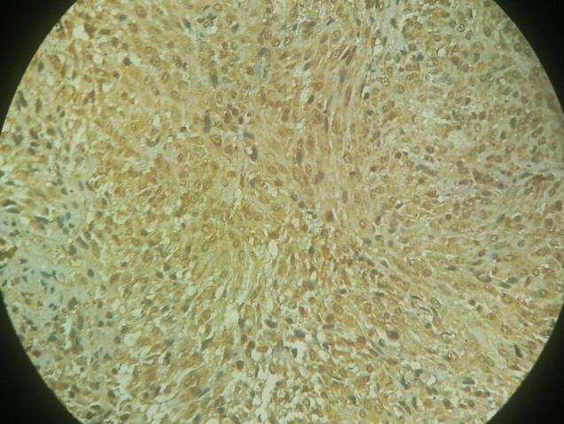 Figure 1: The section shows monophasic spindle cell component of Synovial sarcoma (H & E 10 X). Figure 3: The section shows cytoplasmic positivity of Vimentin in tumor cells (IHC-10 X).
